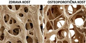 "mikroskopski" prikaz zdrave i osteoporotične kosti